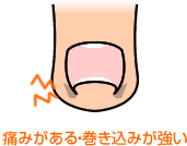 痛みがある・巻き込みが強い