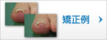 矯正例